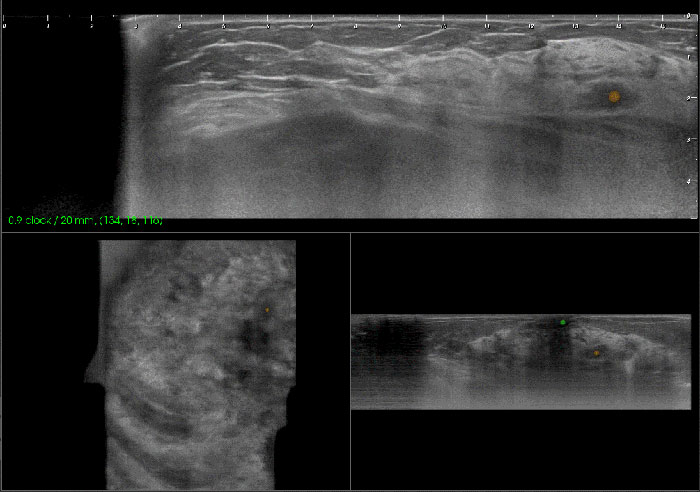 BR-USCADe – Integrated artificial intelligence technology automatically detects abnormalities.